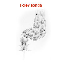 Foley Sonda